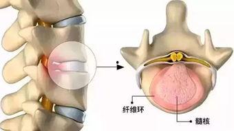 哪些明星腰椎间盘突出