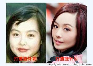 打过瘦脸针的明星图片,明星们的瘦脸针揭秘